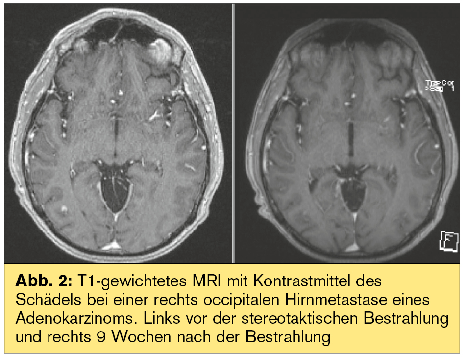 Hightech gegen Metastasen | univ-innere-medizin